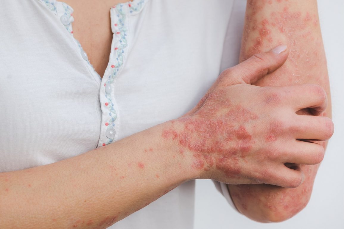 What Miamians Can Do to Prevent Psoriasis Flare-Ups