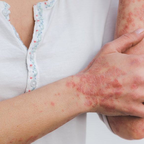 What Miamians Can Do to Prevent Psoriasis Flare-Ups